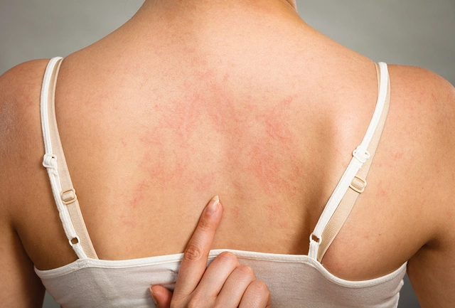 Understanding Irritant Contact Dermatitis: Causes and Treatments